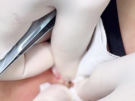 后背上长眼睛 是个什么东西 #粉瘤 #皮脂腺囊肿 #粉刺 #抖出健康知识宝藏 #医疗健康创作训练营