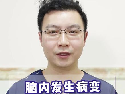 出现这些情况可能是脑内发生了病变,记住了吗?#四川 #科普