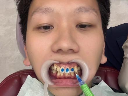 #矫正牙齿 #牙齿
粘完托槽后你们痛几天?