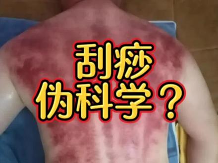 刮痧,伪科学? #刮痧