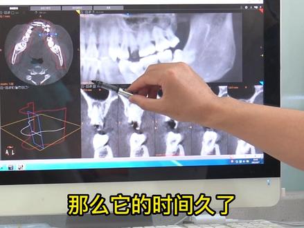 来找我的患者在解决要处理的牙齿问题的同时我还会将口内的其他问题讲给患者!让患者第一时间知道自己的问题!#口腔健康 #医学科普 #口腔科庄锐