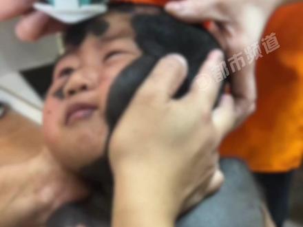 产检没发现 结果孩子基因突变?出生时满身都是“兽皮痣”!妈妈:孩子身上90%都是,几乎没有好皮#万万没想到 #健康 #奇闻奇事 #宝宝