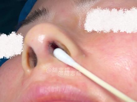 #隆鼻 #鼻整形 #变美那些事 #鼻综合 #做完鼻子后的改变 隆鼻后鼻孔里面长个疙瘩是怎么回事呢!简单处理一下就好了。