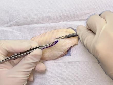 用鸡翅模拟做全切双眼皮#鲁华小清新双眼皮 #全切双眼皮