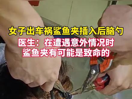 看着都痛!#女子出车祸鲨鱼夹插入后脑勺 姑娘们雪天出行也千万别戴鲨鱼夹呀!