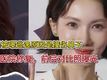 金晨被曝逃逸原因是撞伤鼻子,紧急回医院修复,前后对比照曝光