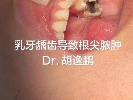 #儿童#龋齿 龋齿导致根尖脓肿、疼痛#根管治疗 #口腔健康