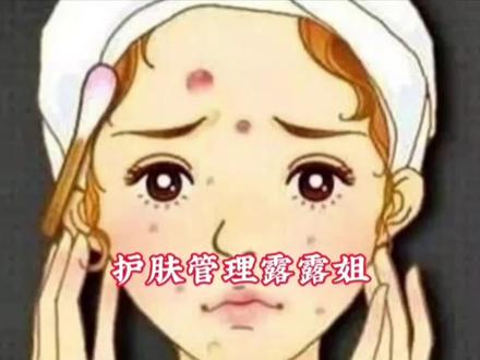 有黑头粉刺闭口痘痘困扰的宝子赶紧点击主页橱窗试试壬二酸水杨酸祛痘修复组合吧#壬二酸水杨酸#祛黑头收缩毛孔 #痘痘黑头粉刺拜拜 #细胞夹去黑头粉刺 #祛黑头粉刺精华液