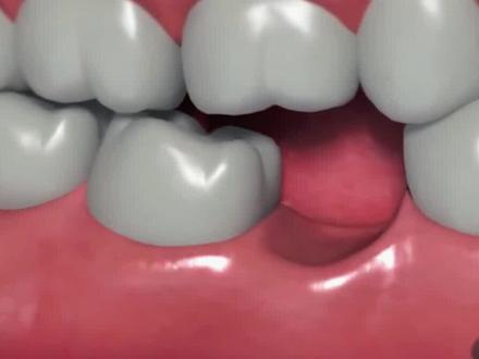 长期缺一颗牙其它牙齿也不好过#口腔科普 #缺牙 #秋季健康周