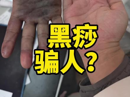 刮痧刮出这样,黑痧是骗人的吗? 评论区高手欢迎大家,请用实践科学来解释一下,这是病气吗?