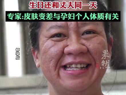 专家辟谣怀儿子孕妈皮肤会变差