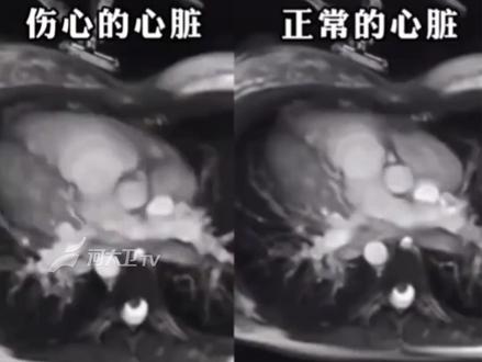 别不信!过度悲伤真的会“心碎”#心碎不是隐喻是身体的呐喊