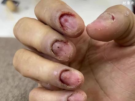 女子频繁美甲指甲感染 #美甲 #美甲教程 #纪录片解说