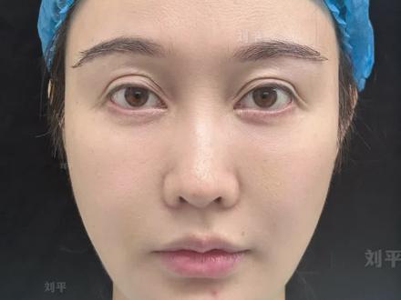 眼尾过长下垂严重 内眼角重塑修复「全集」 #双眼皮修复 #内眼角修复 #眼尾下垂 #双眼皮手术 #刘平眼修复