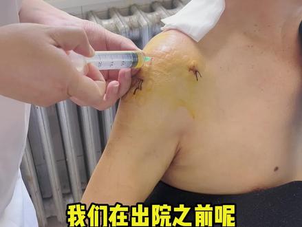 肩袖损伤术后打PRP可以促进肩袖的愈合和生长 如果我们的肩袖损伤小,也可以注射PRP用于促进肩袖生长#肩袖损伤 #肩袖撕裂 #河南省中医院郑永智 #PRP #肩袖
