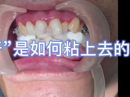 #牙齿矫正 有很多朋友们对牙套的粘接很好奇~可以看一下了解一下