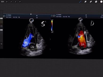 尼奎斯特极限#脉冲重复频率prf、层流湍流和混叠效应。