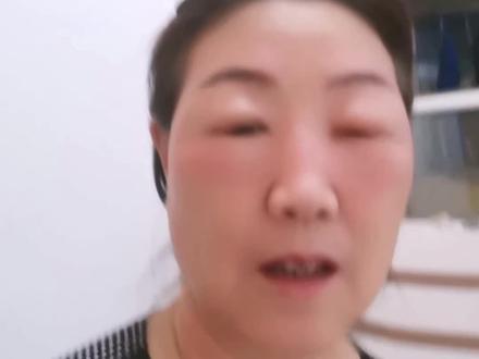 这紫外线灯对我可太灵了,只要是在开着紫外线灯的屋子呆半天被紫外线灯照到的地方就痒的难受,第二天就肿的这样,到药店拿点药吧,他给我的是葡萄糖酸锌口服液,还有盐酸左西替利嗪片,有复方樟脑乳膏,这膏我也不敢往眼睛周围擦呀,药店的这个营养品,跟完美的营养品那不是一个档次呀,完美是专业研究保健品的,还是用完美产品解决这个问题比较放心,用芦荟胶代替那个膏,擦到眼睛里对眼睛还好,平时想不到往眼睛里擦,这下正好打着这一管擦吧,用完美的保健品代替药店的VC和葡萄糖酸锌口服液,再用一生糖、臻萃舒、矿物粉排排毒,静等结果吧!