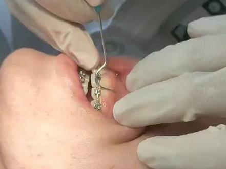 矫正牙齿打骨钉——没有想象的恐怖