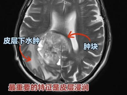 胶质母细胞瘤
#医学影像 #磁共振 #胶质母细胞瘤