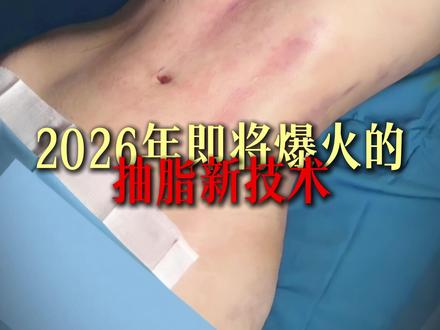 2026最流行的抽脂新技术✅ #腰腹环吸 #手臂环吸 #塑形 #减肥 #身材管理