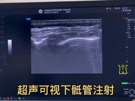 超声可视下骶管注射 #肌骨超声介入 #骶管注射#腰骶部疼痛