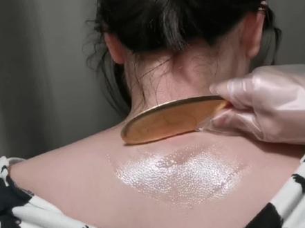 大椎刮痧退热#中医外治法