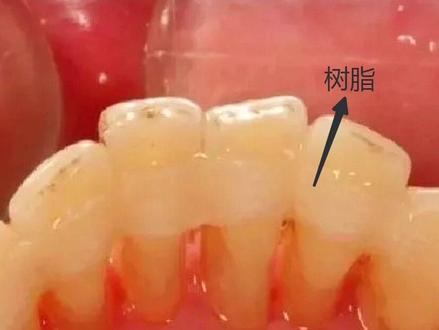 牙周炎导致牙齿松动可以这么固定 #牙周炎 #松牙固定术