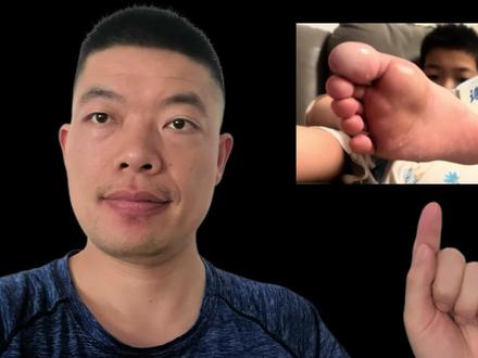 天气变热了了,儿子脚底板发白,气味熏天,医生说是真菌感染。
