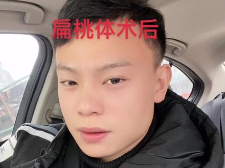 那些想做扁桃体手术的朋友一定要把我这个视频看完 绝对是对你有用 想减肥的朋友更要仔细的看完 可以问我感受。