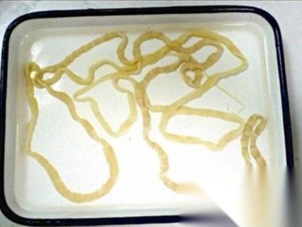 湖南女子体内排出4.95米白色绦虫#社会百态 #传递正能量 #热点新闻事件