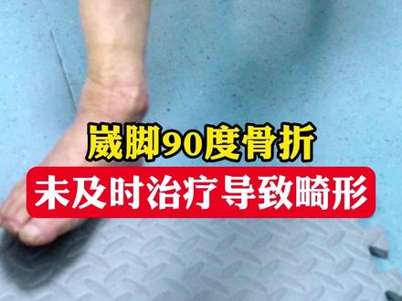 崴脚90度,未及时治疗导致畸形#崴脚 #健康科普