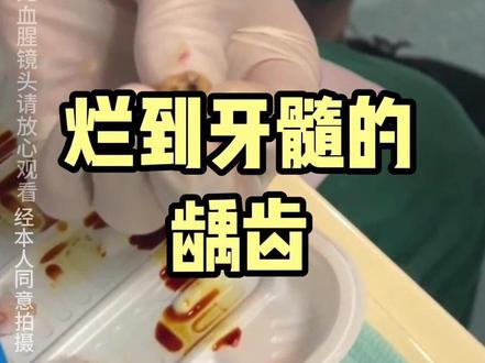 注意,龋齿是会烂到牙髓的#武汉拔牙 #武汉口腔医生孙明宇 #开启硬核医学科普时代
