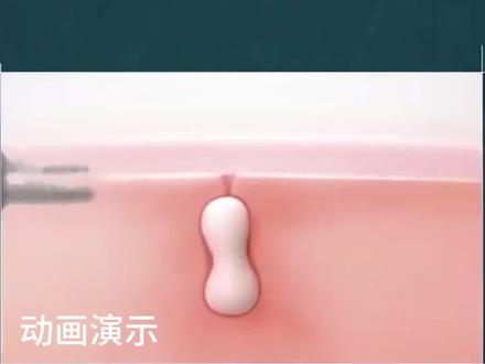 青春痘、痘痘、粉刺、闭口、硬块痘!反反复复影响颜值,#试试它#皮傲宁胶态硫祛痘膏#祛痘淡印#改善痘肌