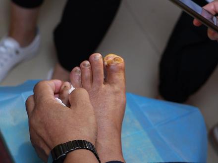 脉管炎脚趾溃烂怎么办#脉管炎 #中医