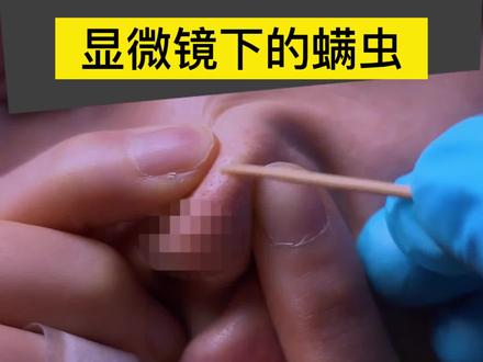 你见过显微镜下的螨虫吗?每天晚上它们都在你脸上蹦迪 #蠕形螨 #螨虫 #dou来说健康 #螨虫被咬后的图
