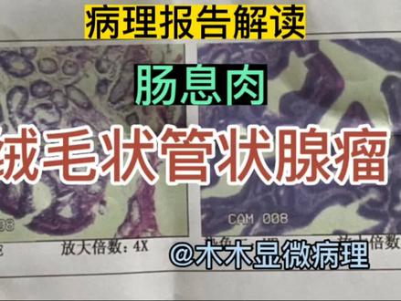 病理报告解读-肠息肉-绒毛状管状腺瘤