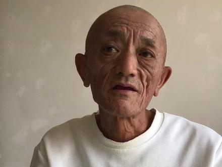 从脚肿到腹水,肝病住院全过程,看完不敢喝了 #黄老二见闻 #戒酒
