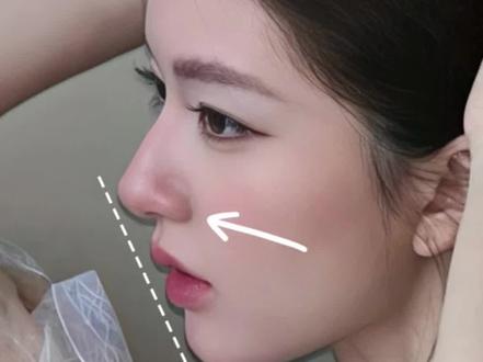 我天…原来鼻基底真的能练嘭!! #鼻基底凹陷