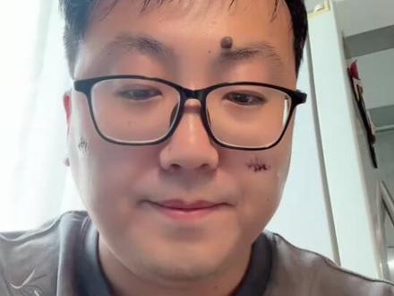 切痣第六天啦~其实不用有太多压力和心理负担的
#切痣 #手术 #切痣分享 #痣的魅力发散时间
