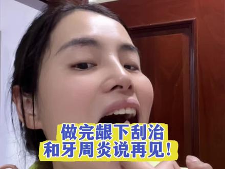 普通洗牙洗不到深处,龈下刮治才是根源 牙龈反复出血口臭|一定要做龈下刮治✨
很多人只洗牙,却清理不到牙龈深处顽固结石
牙龈红肿、牙缝变大、牙齿松动
都是龈下结石在作怪
专业龈下刮治,深层清理牙根污渍
修护受损牙周,告别口腔困扰
好好护牙,才是最低成本的养生
#龈下刮治 #牙周治疗 #牙龈出血 #牙周炎
#口腔健康知识科普