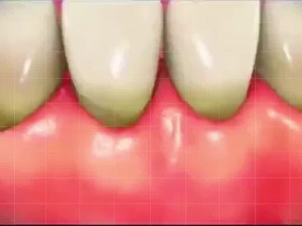 中、重度牙周炎如何治疗?#口腔科普 #牙周翻瓣术 #牙周炎