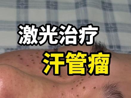 激光治疗汗管瘤 不复发不留疤 #第一视角 #沉浸式体验 #汗管瘤 #抖出健康知识宝藏 #我的年度健康盘点