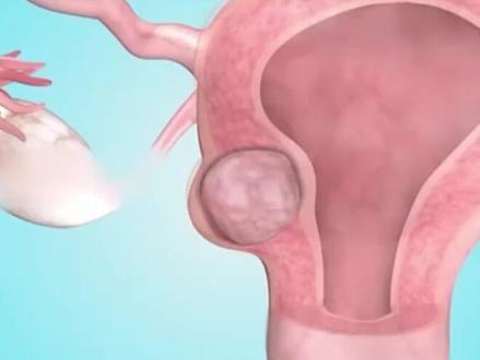 肌瘤超过五公分,必须开刀吗? #子宫肌瘤#抖出健康知识宝藏#医学科普#医疗健康创作训练营#微创手术