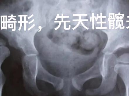 #传递健康与美丽 发育性髋关节脱位