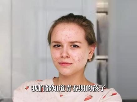 青春期前痤疮?家长注意!#痘痘 #痤疮 #闭口 #抖出健康知识宝藏 #健康科普破圈计划