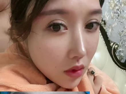 人中做完半年了真的一点痕迹也没有,今天终于对我的人中窝下手了!这个地方说一点感觉没有是假的,本来就敏感的地方,我现在真的好疼疼啊。素颜磨皮开到最小,给你们看看刚做完六个小时后的样子。窝窝一加深我感觉面部又立体的不小,坐等恢复吧!#变美那些事