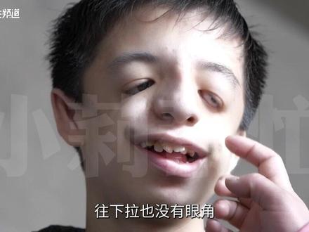 15岁男孩患有“鸟面综合症”脸部缺少骨头长相似鸟,母亲:“孕检未查出孩子患有这种疾病”#河南dou知道