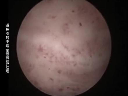 R流后的#子宫 很难受,女孩子们要好好保护自己#医学科普 #关爱女性健康