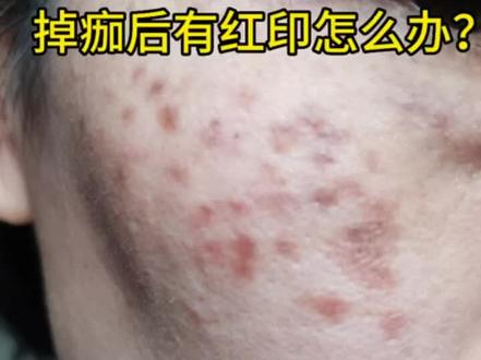 祛斑掉痂出现了红印是很多人都会出现的,这是炎症反应导至,应及时的处理,否则红完就变黑了#斑点 #做斑 #祛斑 #问题性皮肤管理 #美业人